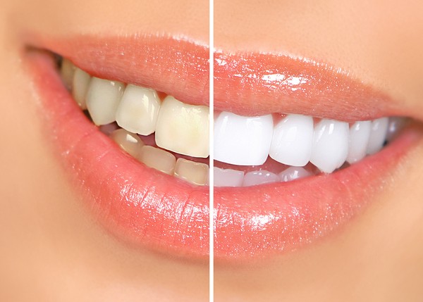 Get rid of teeth stains